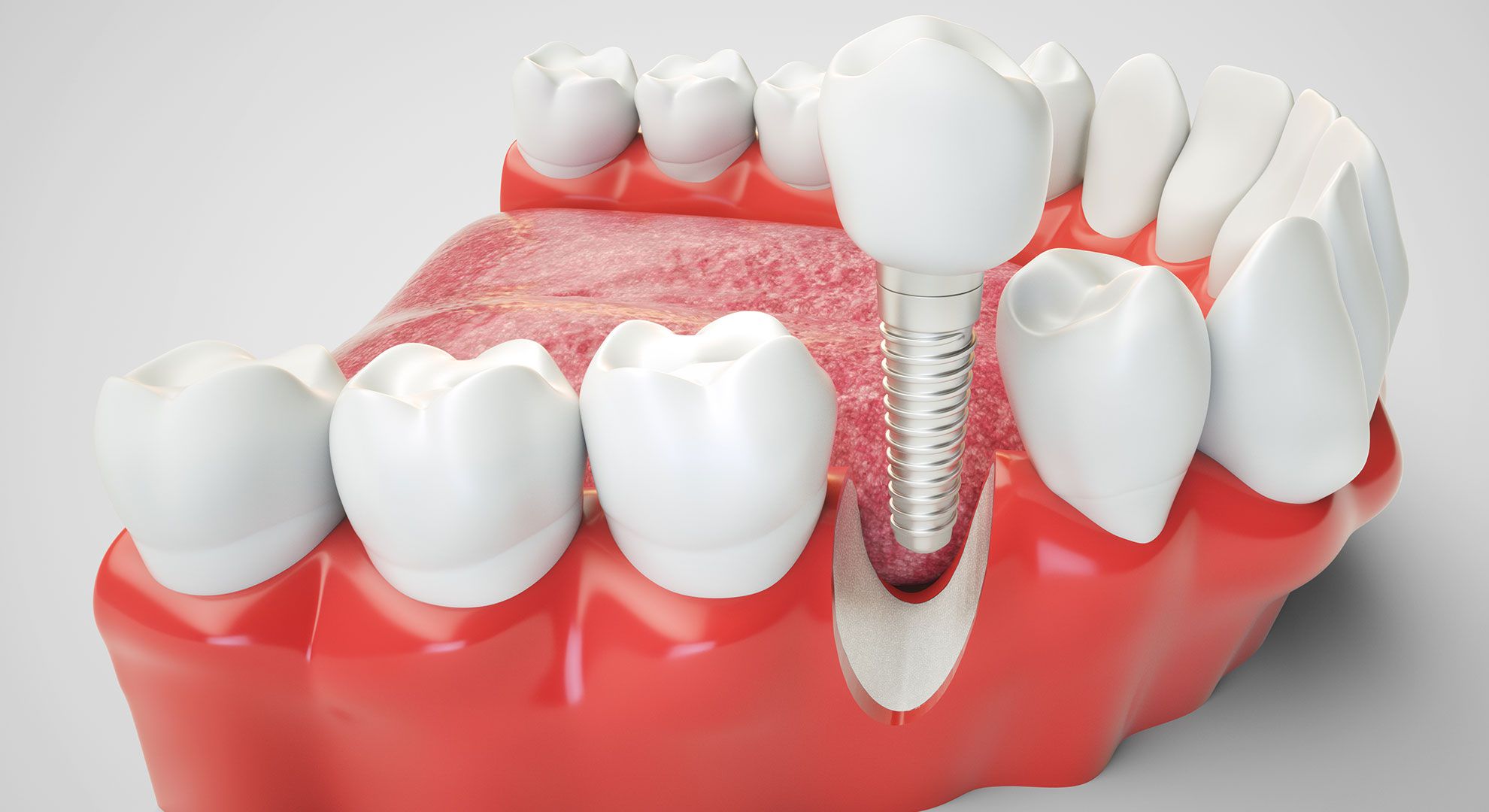 Implante Dentário - São José dos Campos