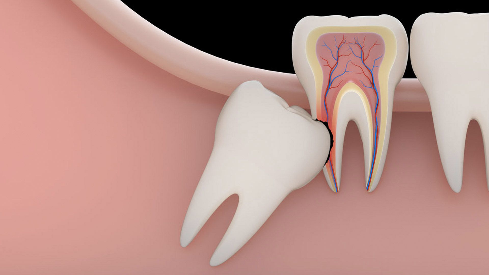 Dente do Siso